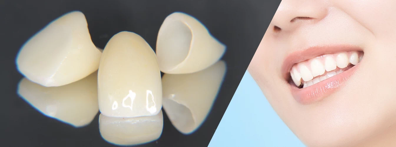 審美歯科治療の様子